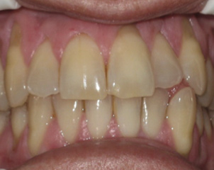 The dentin is visible through the thinning enamel of these teeth.
